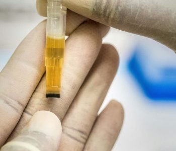 Cómo Pasar un Examen de Orina en Chile