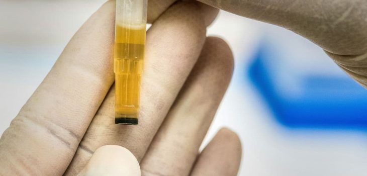 Cómo Pasar un Examen de Orina en Chile
